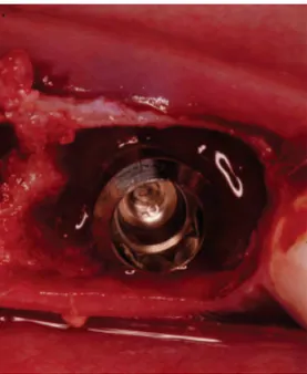 Figure 14 : Une extraction implantation sans  comblement du gap péri-implantaire, réalisée chez  le chien dans l’étude d’Araujo (Araujo et al