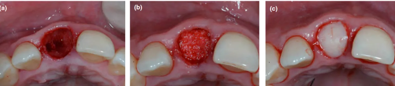 Figure 16 : Séquence opératoire d’un comblement alvéolaire post-extractionnel d’une incisive centrale maxillaire chez  l’Homme