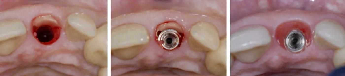 Figure 19 : La technique du socket-shield d’après Hürzeler. A gauche : alvéole post-extractionnelle avec le fragment radiculaire en  vestibulaire après le passage des forets