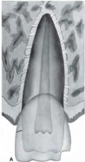 Figure 1 : Fracture amélaire 