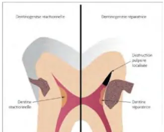 Figure 6 : Dentine réactionnelle et réparatrice 