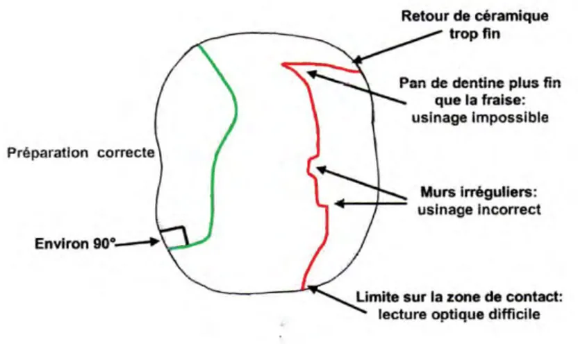 Figure 1 : schéma illustrant une préparation correcte pour un inlay onlay (en vert), et les erreurs à  éviter (en rouge) 