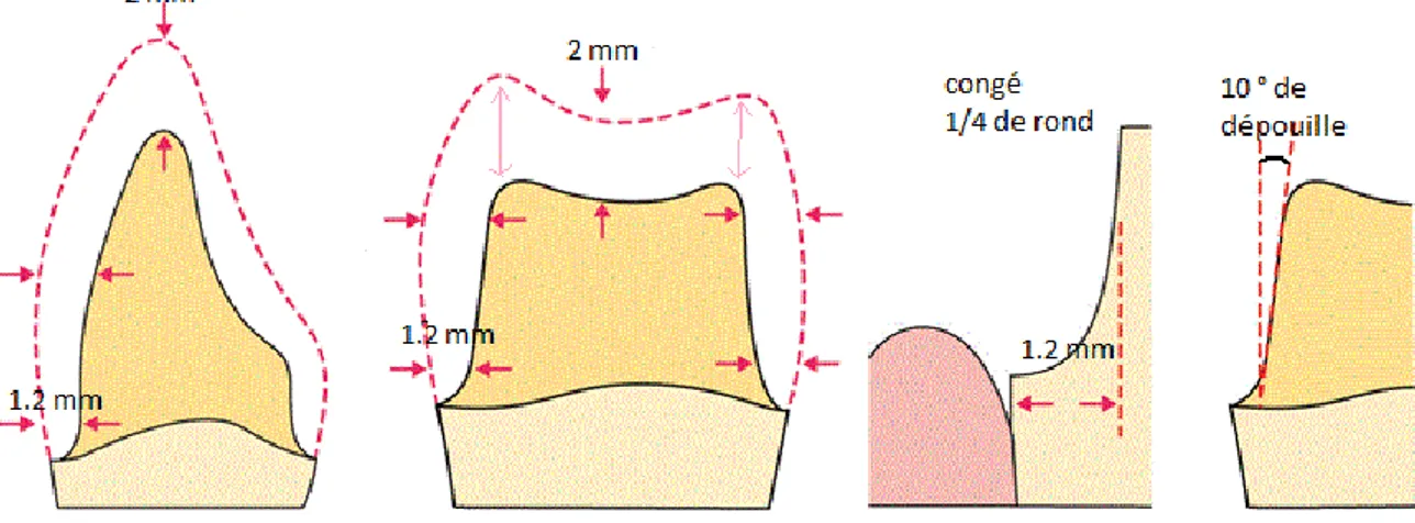 Figure 2 : représentation schématique d’une préparation type pour une reconstitution par  couronne sur une incisive et une molaire en vue proximale 