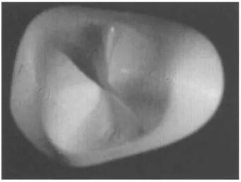 Figure 11 : photographie d’un modèle de couronne dentaire fabriquée par stéréolithographie  [57]