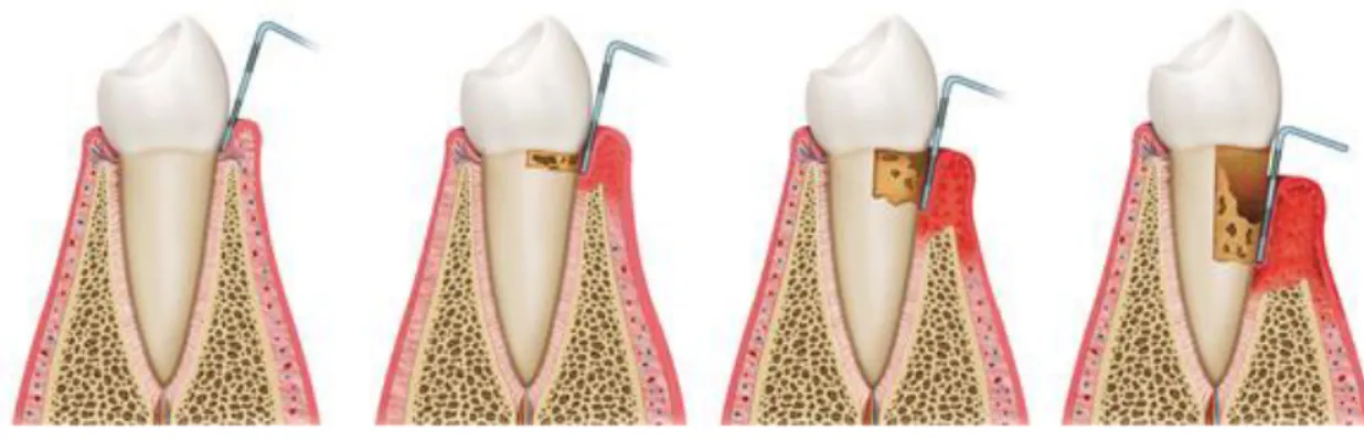 Figure 7 : La maladie parodontale  Image issue du site « Dentagora.fr » (33) 