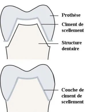 Figure 8 : Le ciment de scellement en Prothèse fixée.  Image issue du site « pocketdentistry.com » (51)  Prothèses amovibles : 