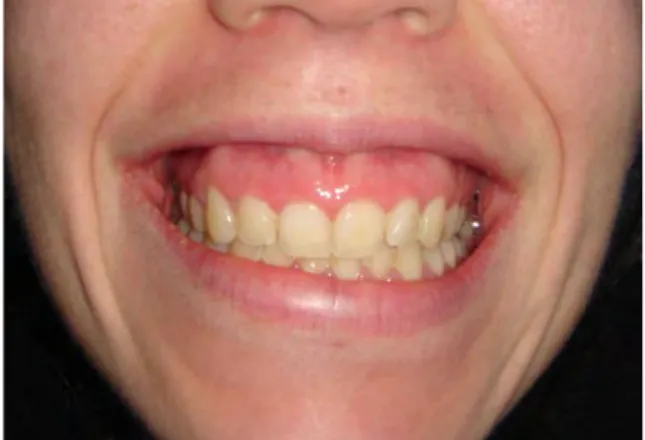 Figure 3 : photo d’un sourire gingival.  Source : google image. 