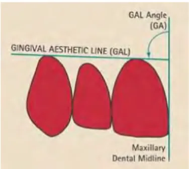 Figure 6 : source : british dental journal : Anterior dental aesthetics: Gingival perspective
