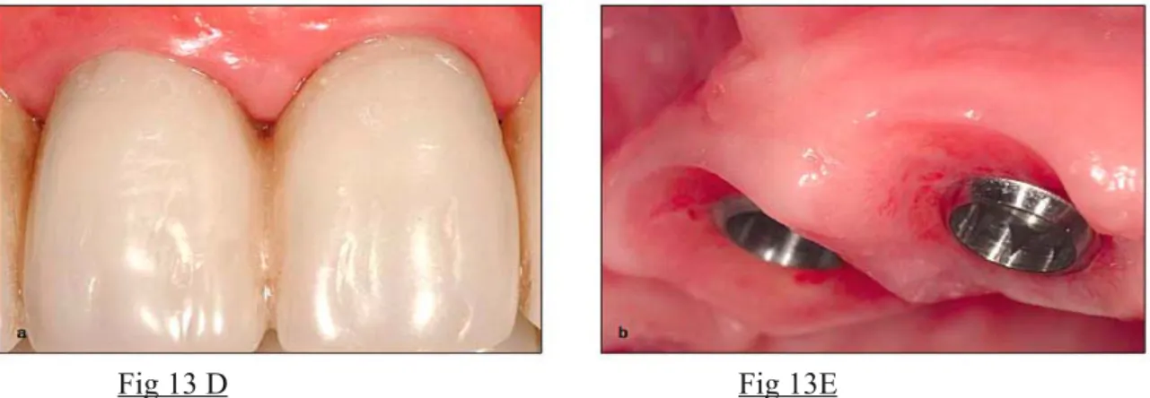 Fig 13A : vue occlusale d'un maxillaire édenté avant chirurgie implantaire et mise en charge immédiate