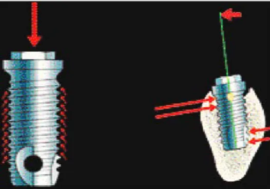 Fig 36 : Les spires de l'implant décomposent  la force transmise dans son axe