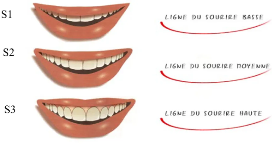 Fig 49   : Les différents types de sourire