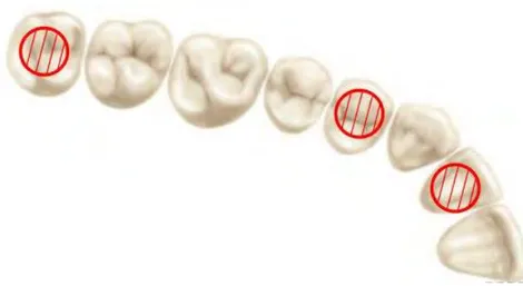 Figure 7: Vue horizontale du secteur 1, les couronnes dentaires présentent des formes très variées par  comparaison avec les cercles rouges représentant les implants