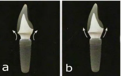 Figure 16 : Vue proximale d’un implant avec le pilier prothétique et sa couronne. a) design concave          b) design convexe 