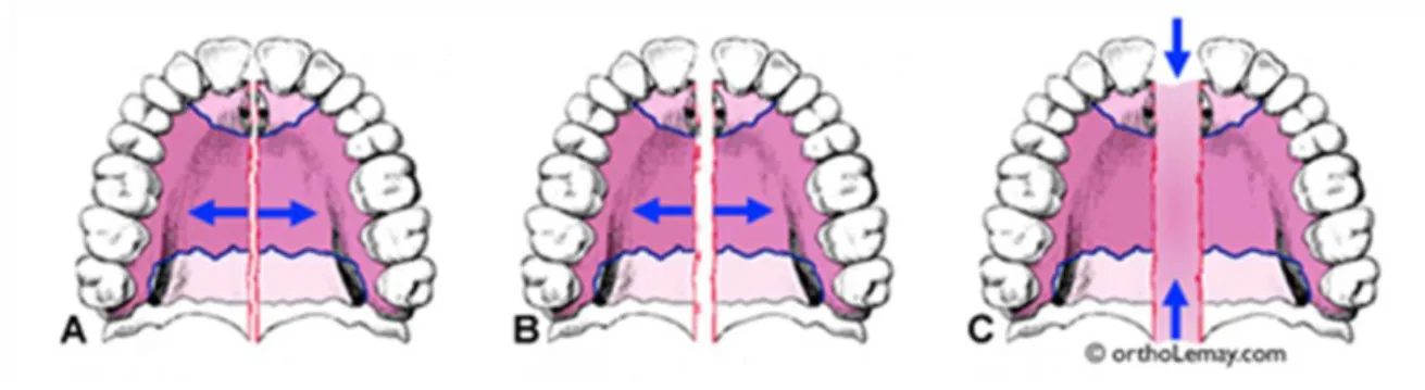 Figure 7 : Mécanismes de croissance de la suture palatine médiane 