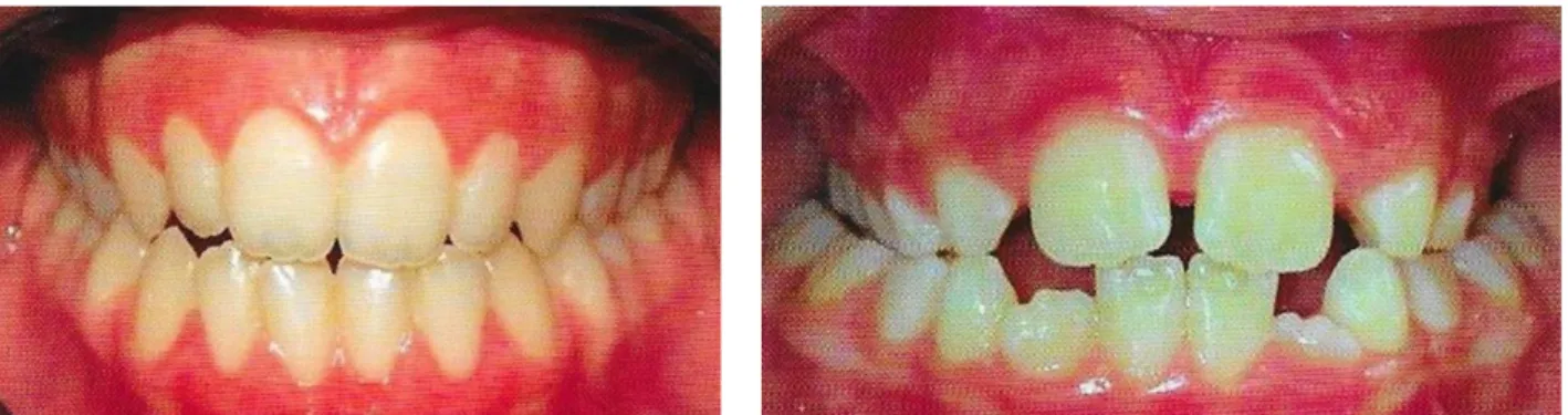 Figure 13 : Différences cliniques entre une endoalvéolie maxillaire à droite et une endognathie  maxillaire à gauche 