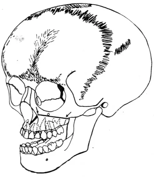 Figure 1- Schéma de Trimble et West (1982), on note une brachycéphalie associée à une proéminence   des bosses frontales ainsi qu'une atrésie maxillaire.