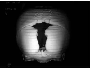 Figure 2- 3D Scan du crâne d'un patient atteint de DCC sur lequel est visible la persistance de la   fontanelle antérieure, Dr Ravi Prakash S