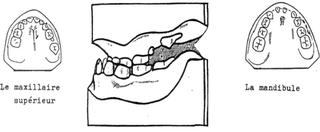 Figure 3- Moulages en plâtre présentés par Bureau (1953) modélisant l'atrésie maxillaire.