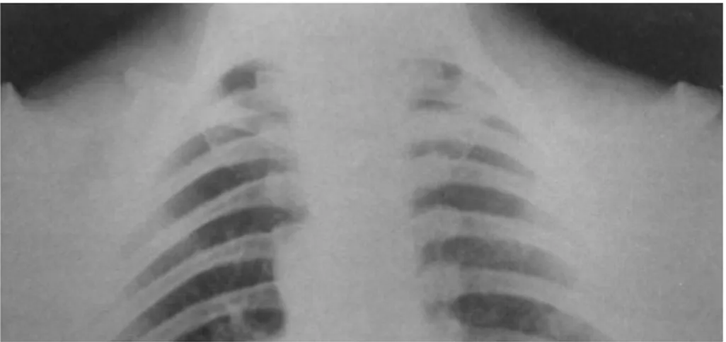 Figure 5- Agénésie des portions latérales des clavicules (Film Courtesy of American College of Radiology,   Reston, Virginia), Dr Victor Feldman, J Can Chiropr Assoc 2002; 46(3) .