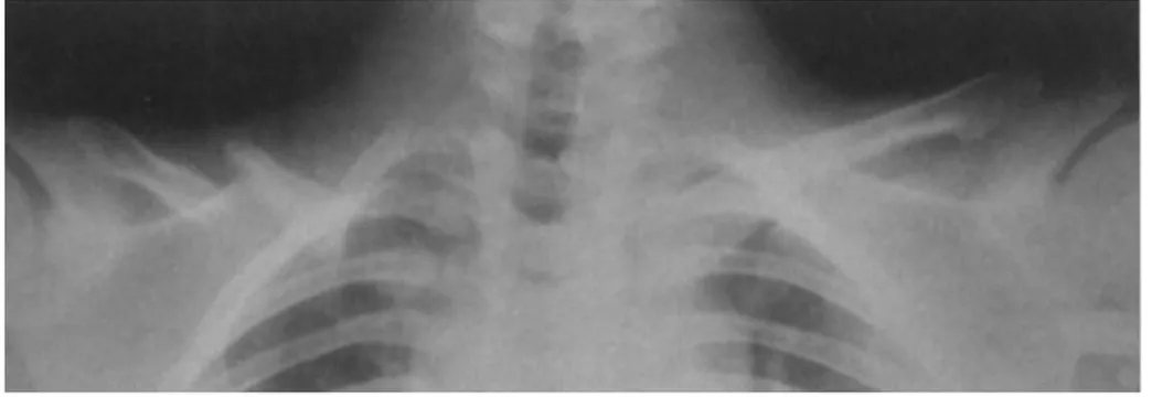 Figure 7- Agénésie de la portion centrale de la clavicule avec une pseudo-arthrose(Film Courtesy of   American College of Radiology, Reston Virginia), Dr Victor Feldman,  J Can Chiropr Assoc 2002; 46(3) 