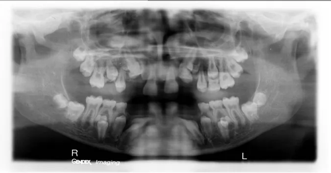 Figure 12- Orthopantomogramme de Benjamin. P, 14 ans (Dr Vaysse).