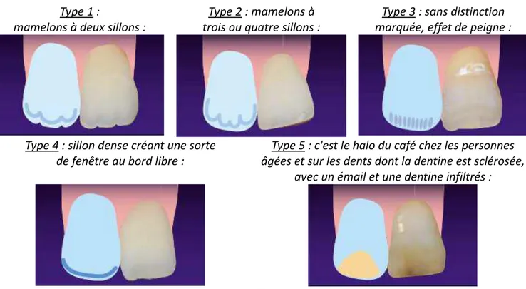 Figure 13 : Schémas des différents types d'opalescences. 