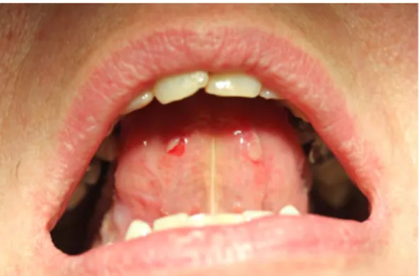 Figure	
  9.	
  Érosion	
  post-­‐bulleuse	
  du	
  ventre	
  de	
  la	
  langue	
  