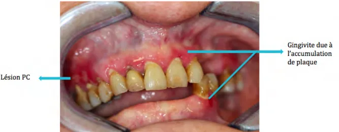Figure	
  13.	
  Hygiène	
  buccale	
  défectueuse	
  :	
  présence	
  de	
  plaque	
  dentaire	
  ainsi	
  que	
  de	
  tartre	
  supra-­‐