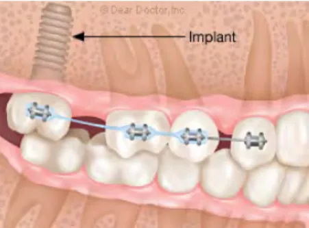 Figure 5: ancrage supra implantaire, http://www.deardoctor.com/articles/dental-implants/page3.php