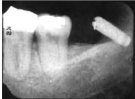Figure 10: mini-plaques d’ancrage, Sugawara et al. (161)