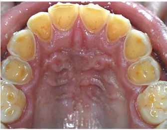 Figure 4 : Exemple d’érosions sévères atteignants la dentine. Vue occlusale du maxillaire (7) 