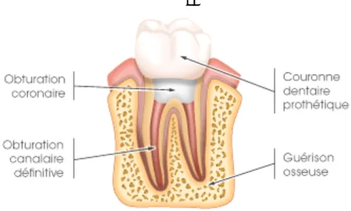 Figure 8 : Molaire couronnée traitée endodontiquement (14) 