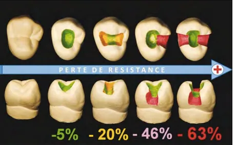 Figure 10 : Diminution de la résistance selon la perte de tissu dentaire (21) 