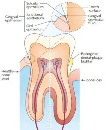 Figure 1. Les effets de la parodontite. Le tissu parodontal en bonne santé (à gauche) contient le desmodonte 