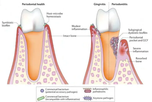 Figure 3. Dysbiose et maladie parodontale. Transition d'un état de santé parodontale et d'une homéostasie 