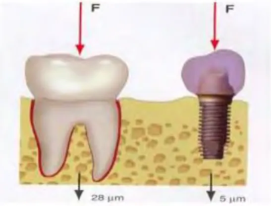 Figure 3 - Schéma illustrant la mobilité axiale de la dent et de l’implant.