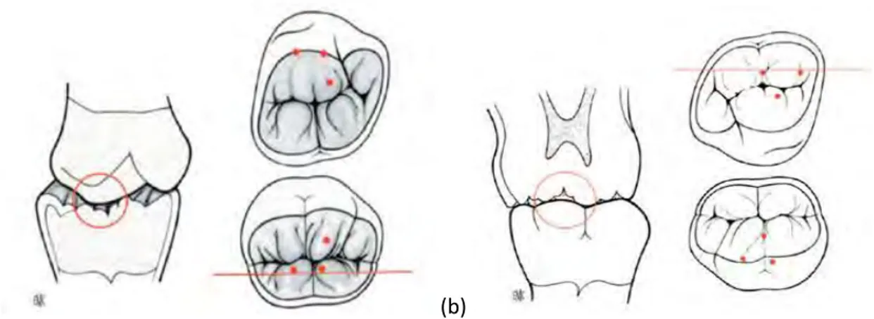 Figure 12 - (a) Schéma illustrant la relation d’une cuspide mésio-linguale maxillaire avec une fosse centrale  antagoniste – (b) Schéma illustrant la relation d’une cuspide disto-vestibulaire mandibulaire avec une fosse centrale 