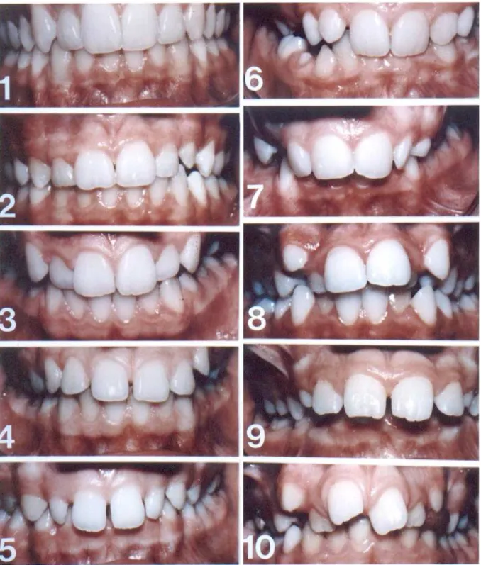 Figure 3: Composante esthétique de l’IOTN : séries de photos polychromes pour  évaluation directe sur le patient. 