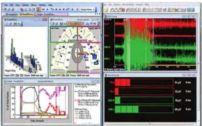 Figure 8 : T‐Scan associé à l'EMG, visualisation simultanée des contacts occlusaux et de  l'activité musculaire [168]     La méthode par palpation est actuellement considérée comme le « gold standard », par  défaut dans l’évaluation de la synchronicité ou coordination musculaire, mais peu décrite  dans la littérature. 