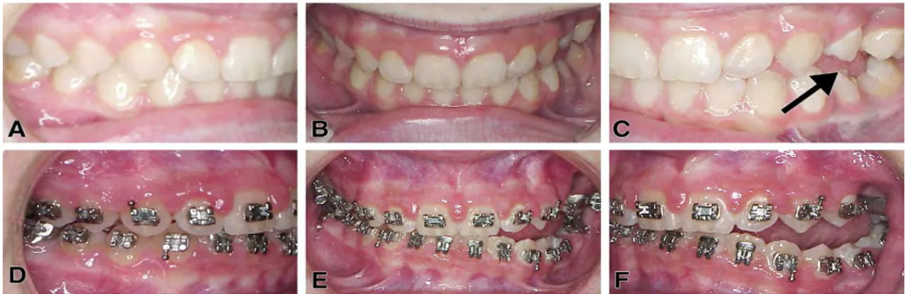 Figure 19. Photographies intrabuccales avant et pendant le traitement orthodontique chez un  patient  qui  présente  un  DPE