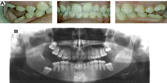 Figure  20.  A-  Photographies  intrabuccales  de  face  et  de  profil  d’un  patient  souffrant  d’un  DPE  et  présentant  des  béances  latérales  postérieures  B-  Orthopantomogramme   (Frazier-Bowers, 2010)