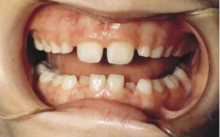 Figure 22. Photographie d’un DMM « transitoire » en dentition mixte (Oesterle, 1999). 