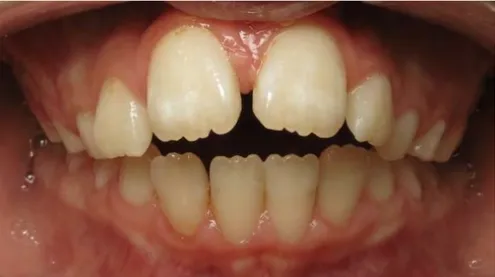 Figure 23. Photographie endobuccale d’un DMM associé à une béance antérieure  (UFR d’orthopédie dento-faciale, Rangueil)