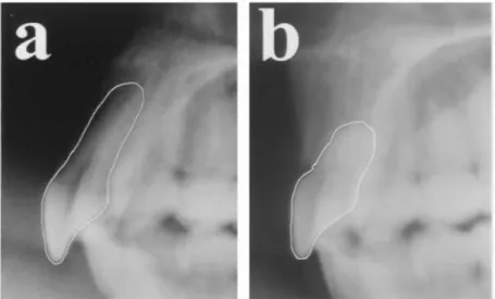 Figure 30. a) rétro-alvéolaire avant traitement orthodontique,                  b) rétro-alvéolaire après traitement orthodontique, 