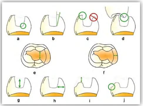 Figure	 3-3	 :	 Principaux	 critères	 de	 préparations	 pour	 inlay/onlay(108)	