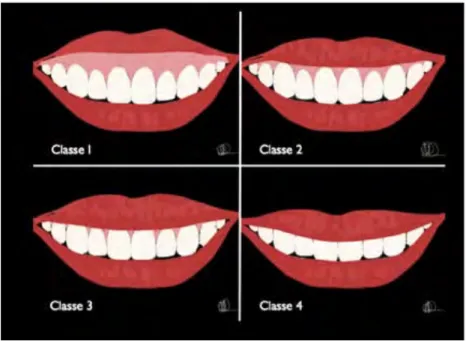 Figure 3. Ligne du sourire basse, ligne du sourire moyenne et ligne du sourire haute  (7)
