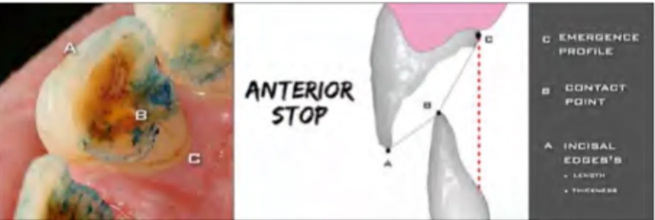 Figure 12. Les trois points à identifiés pour la réalisation du stop antérieur  (20)