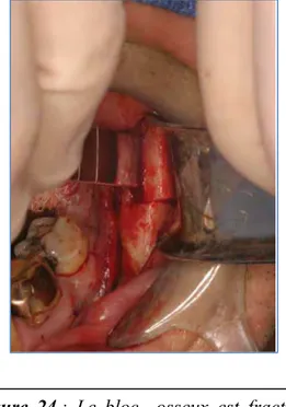 Figure 23  :  on  réalise  une  incision 