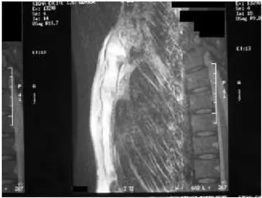 Figure 14 : IRM, plan sagittal de la paroi thoracique antérieure avec suppression de graisse montrant une ostéite sternale avec une ostéo-arthrite manubrio-sternale et sterno-claviculaire (9)