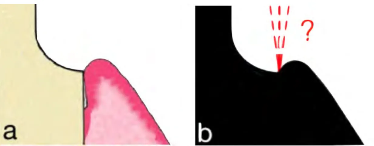 Figure	5	:	a)	coupe	d’une	préparation	intrasulculaire,	les	tissus	mous	sont	au	contact	de	la	racine.	 b)	coupe	du	modèle	en	plâtre	obtenu	par	le	prothésiste	avec	perte	d’information	concernant	le	profil	 d’émergence.	Le	profil	d’émergence	radiculaire	est	inexistant.	
